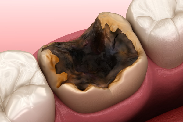 虫歯治療画像